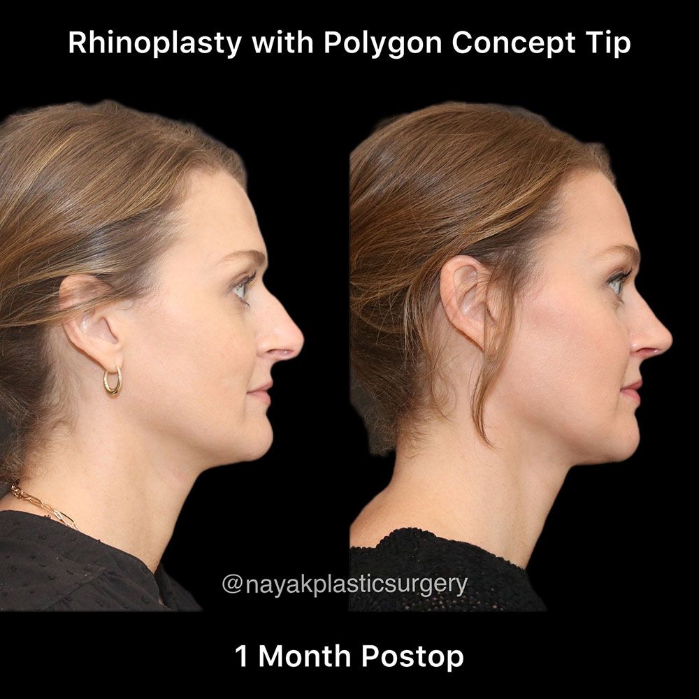 Rhinoplasty Before & After