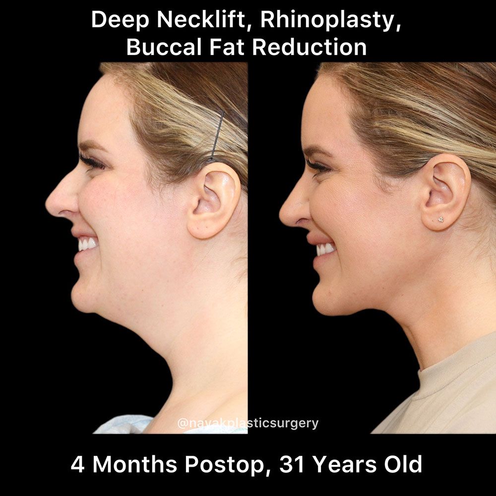 Rhinoplasty Before & After