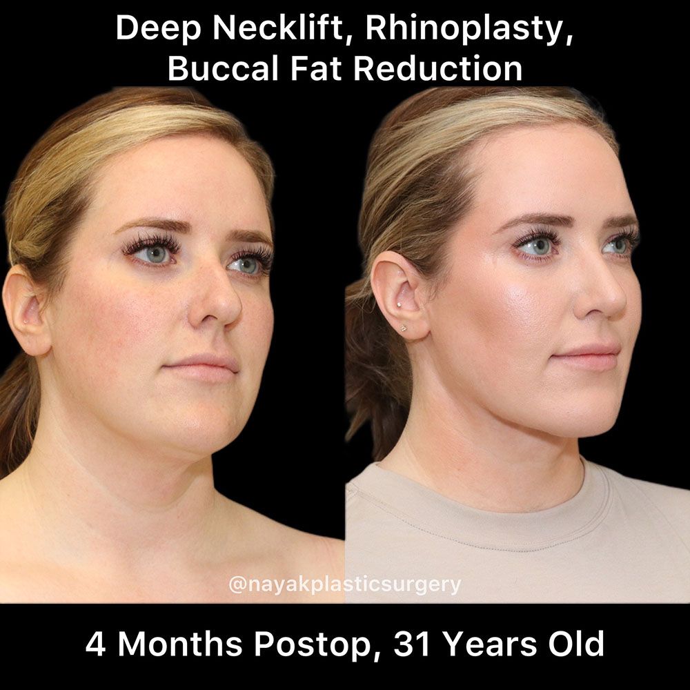 Rhinoplasty Before & After