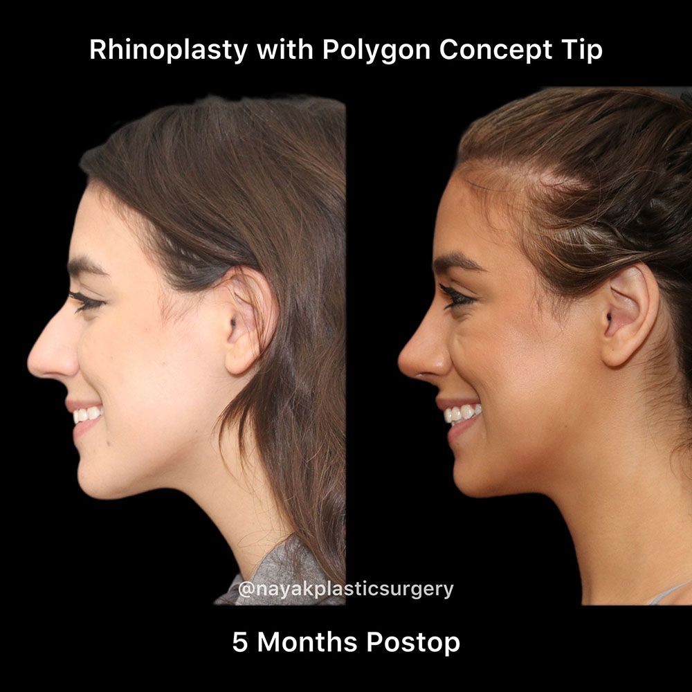 Rhinoplasty Before & After