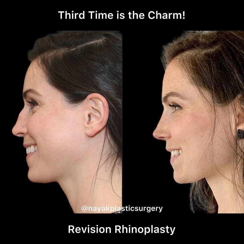 Rhinoplasty Before & After