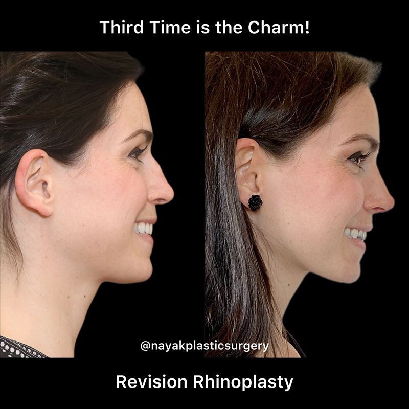 Rhinoplasty Before & After