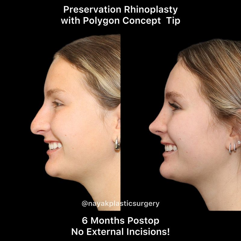 Rhinoplasty Before & After