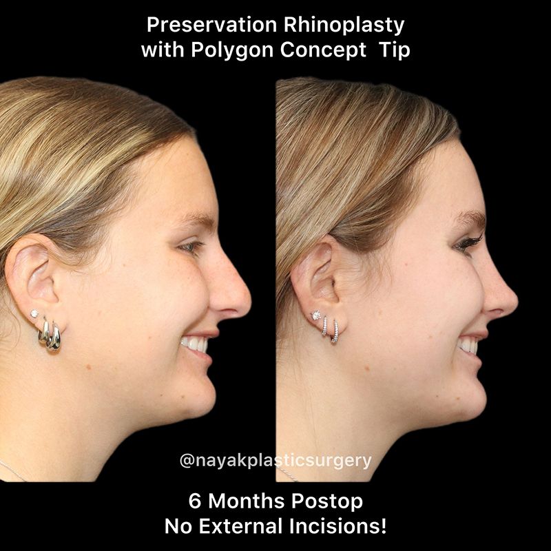 Rhinoplasty Before & After