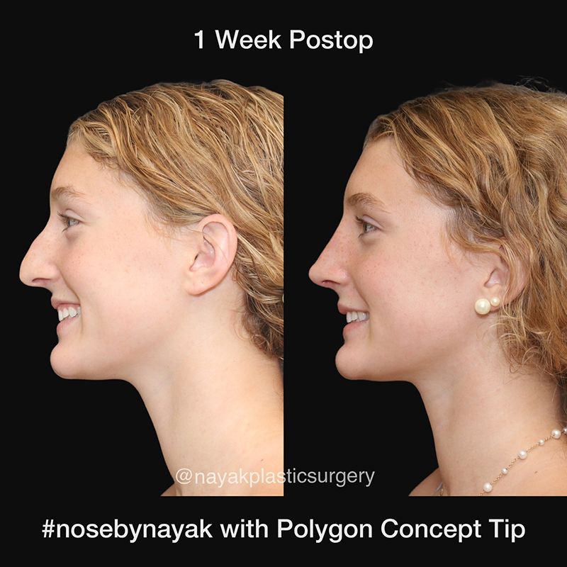 Rhinoplasty Before & After