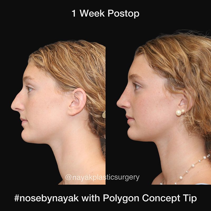 Rhinoplasty Before & After