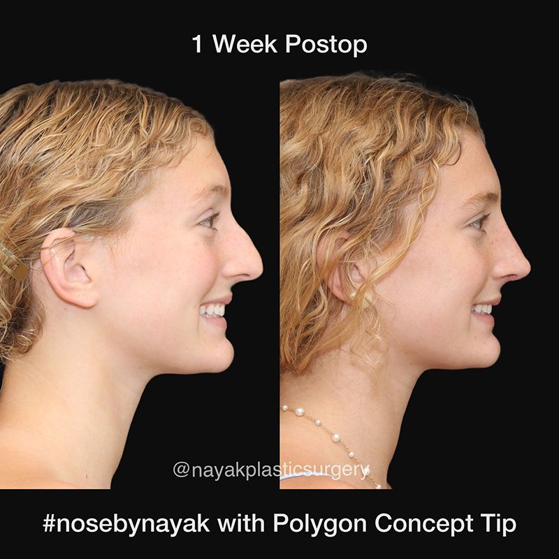 Rhinoplasty Before & After