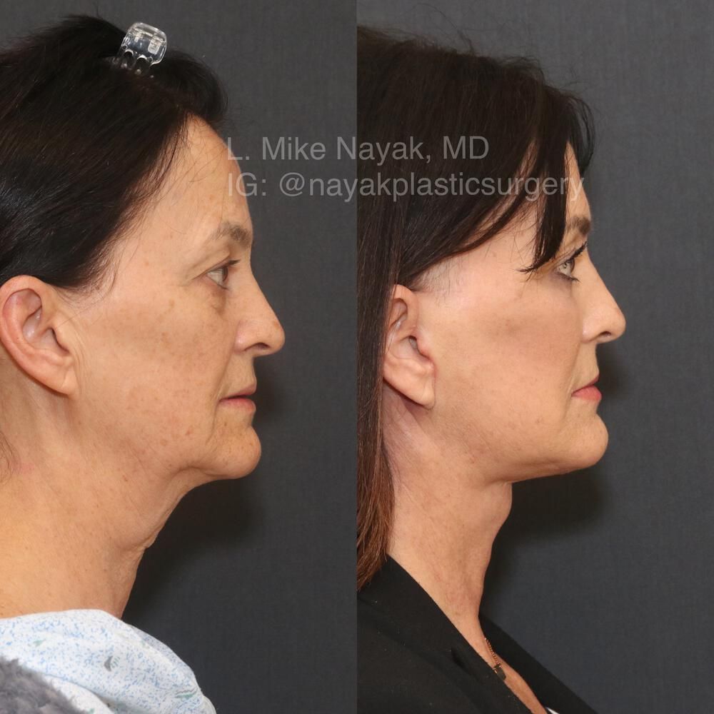 Blepharoplasty Before & After