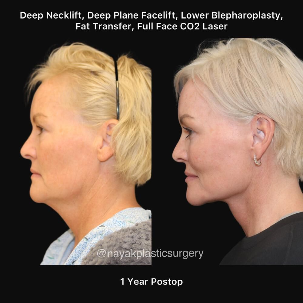 Blepharoplasty Before & After