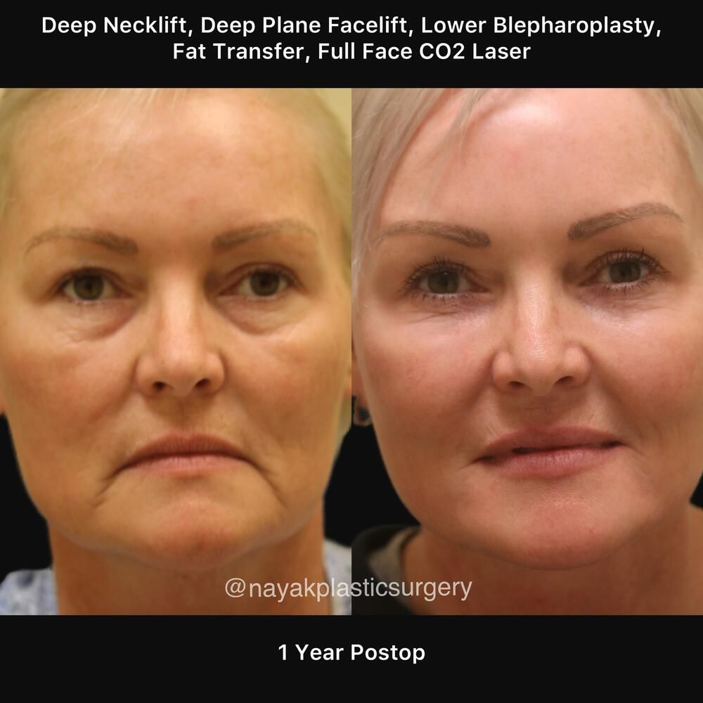 Blepharoplasty Before & After