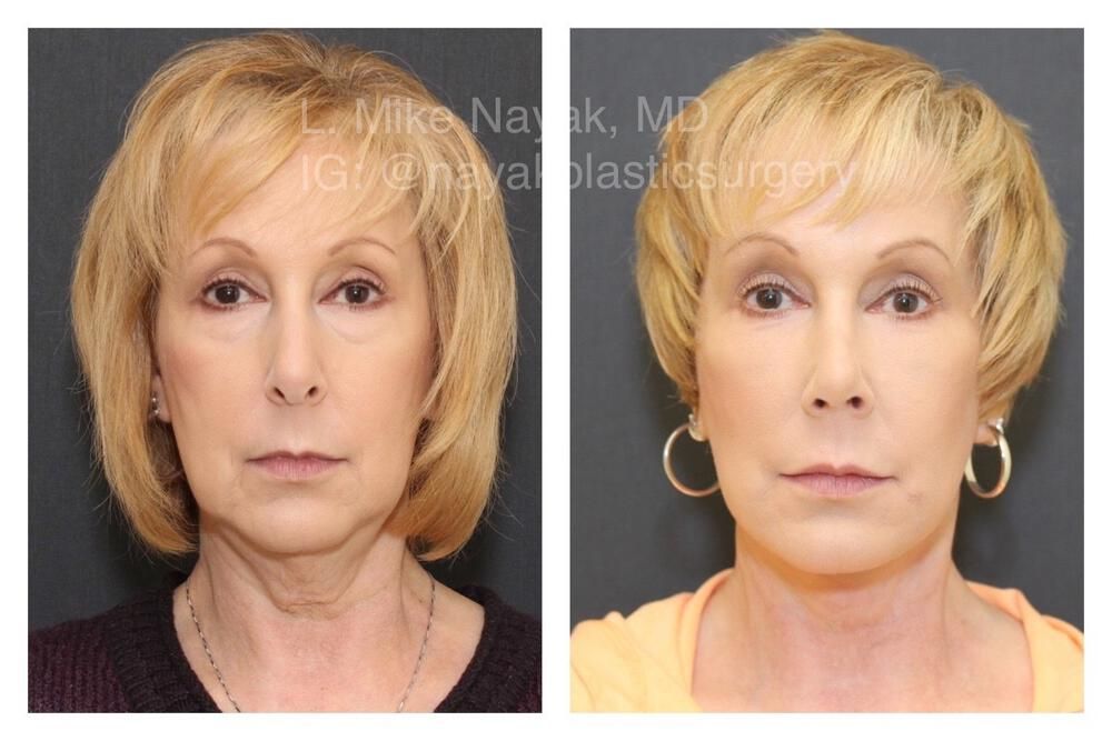 Blepharoplasty Before & After