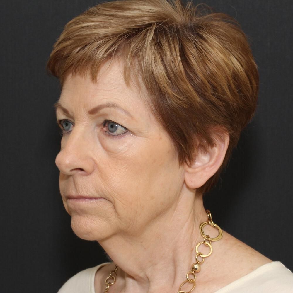 Blepharoplasty Before & After