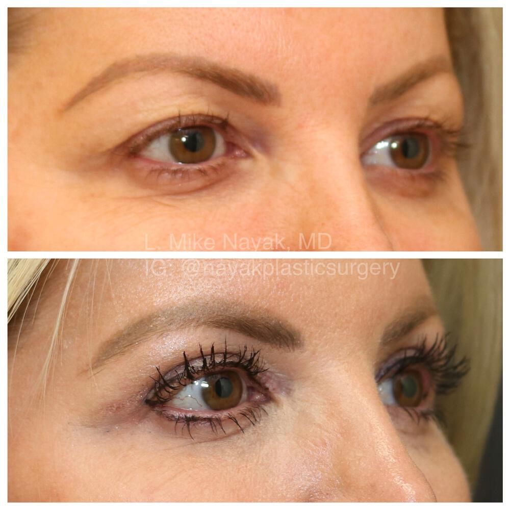 Blepharoplasty Before & After
