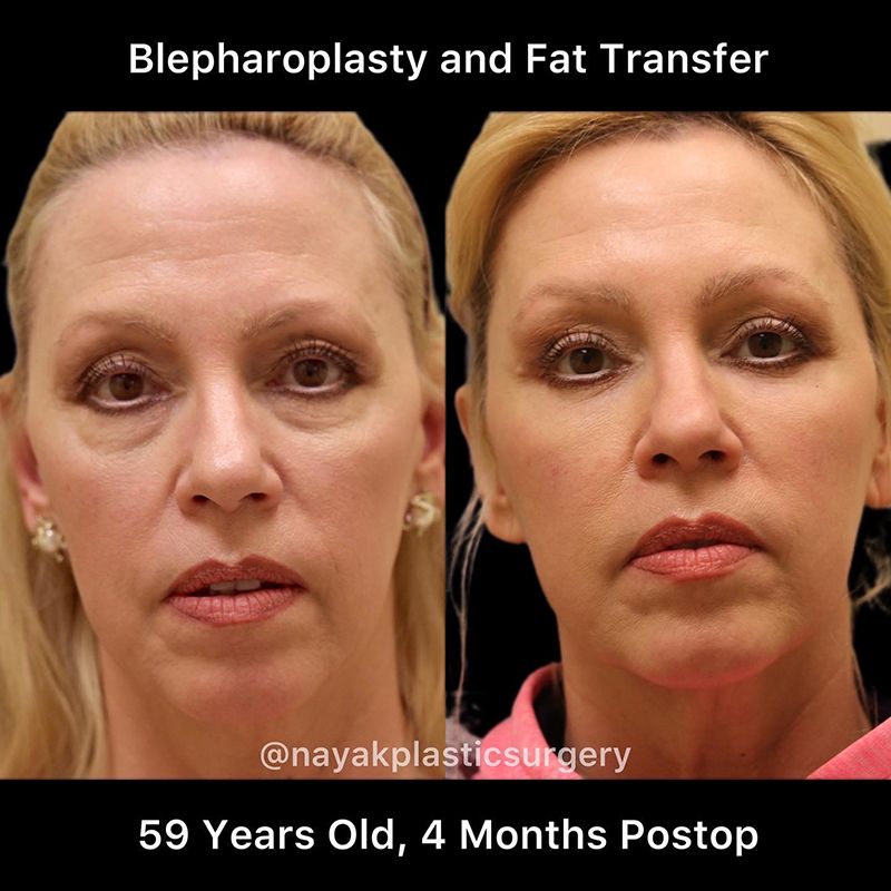Blepharoplasty Before & After