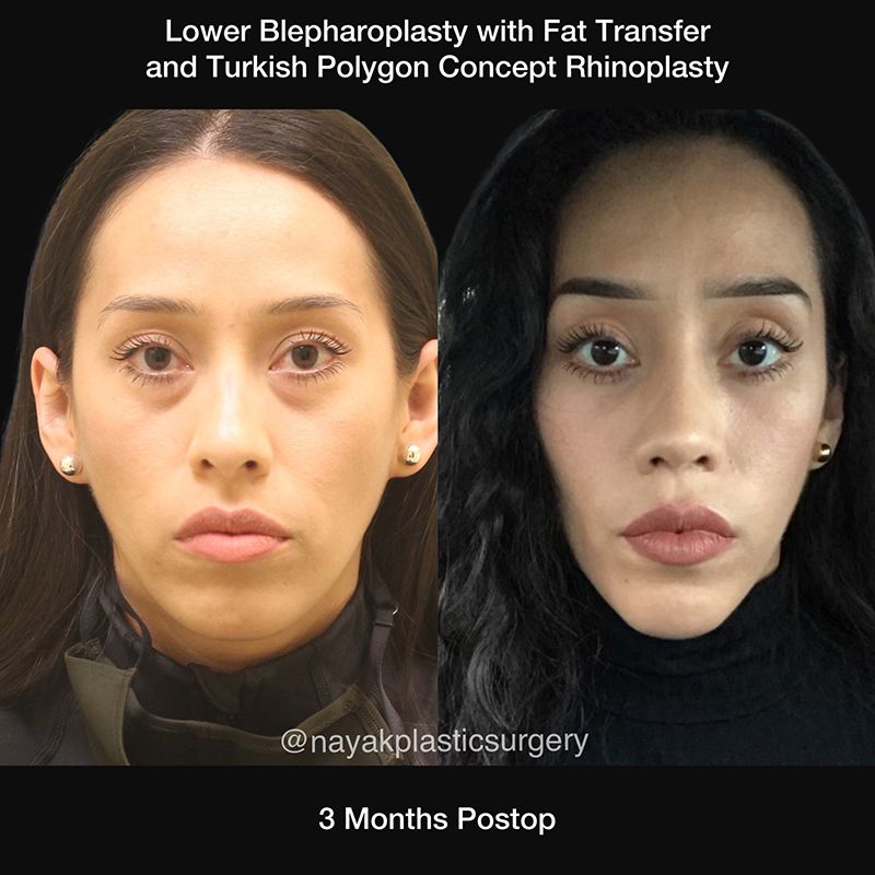 Blepharoplasty Before & After