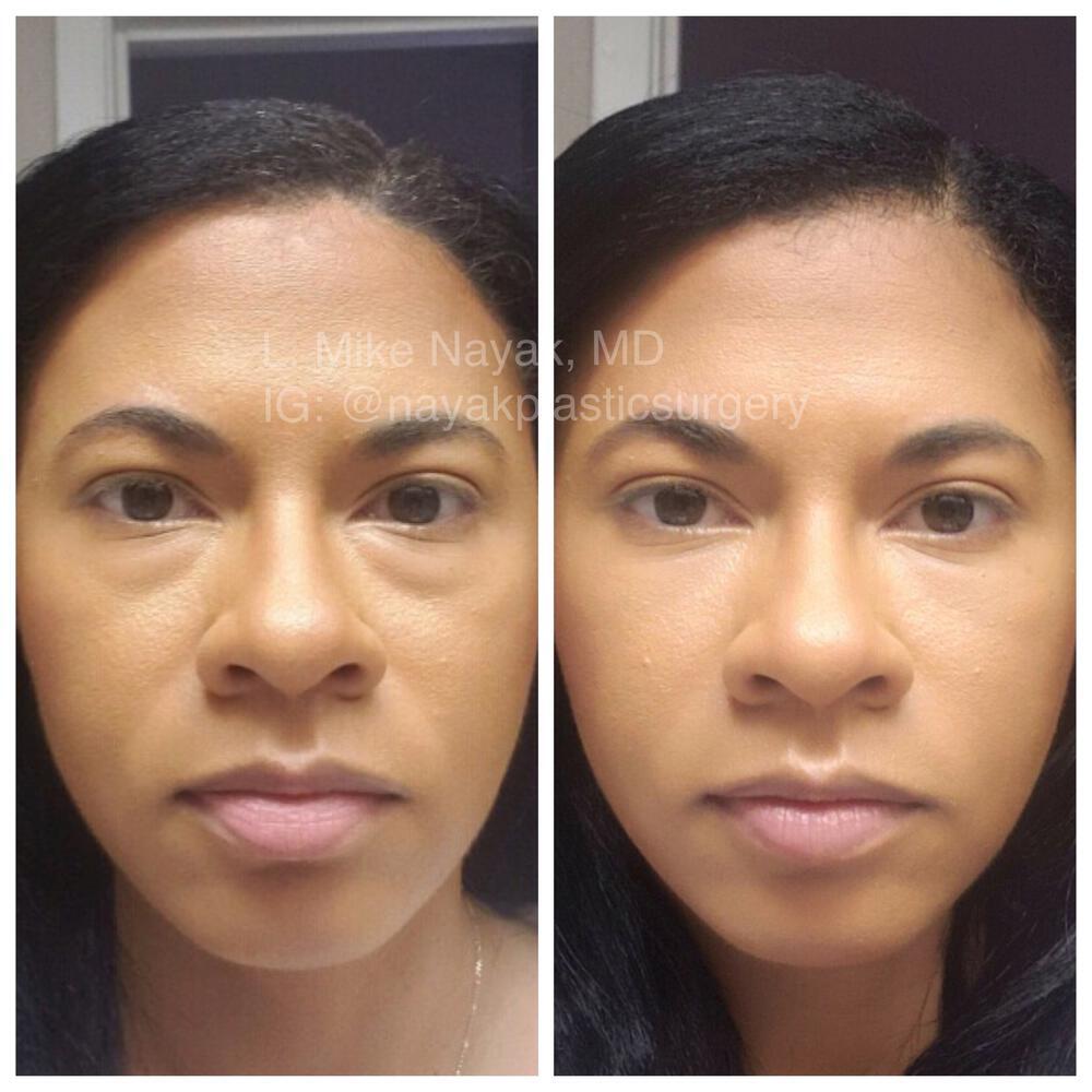 Blepharoplasty Before & After Image