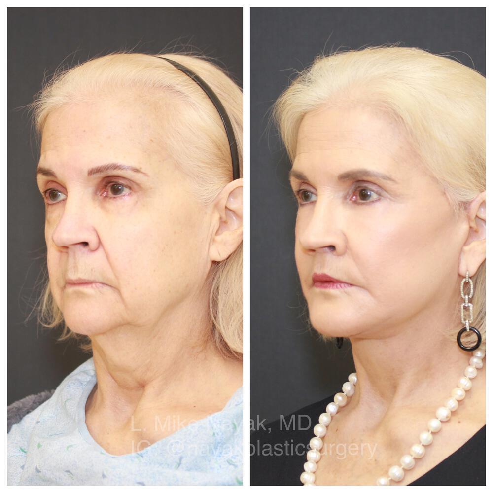 Blepharoplasty Before & After Image