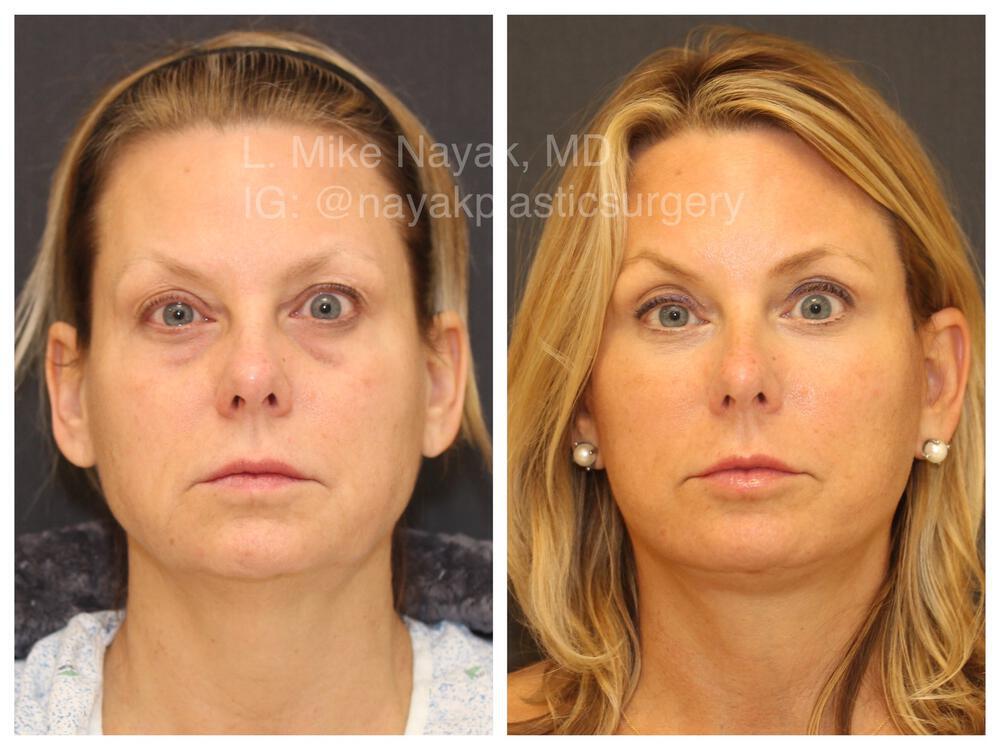 Blepharoplasty Before & After Image