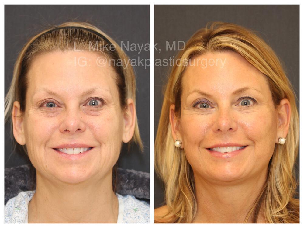 Blepharoplasty Before & After Image