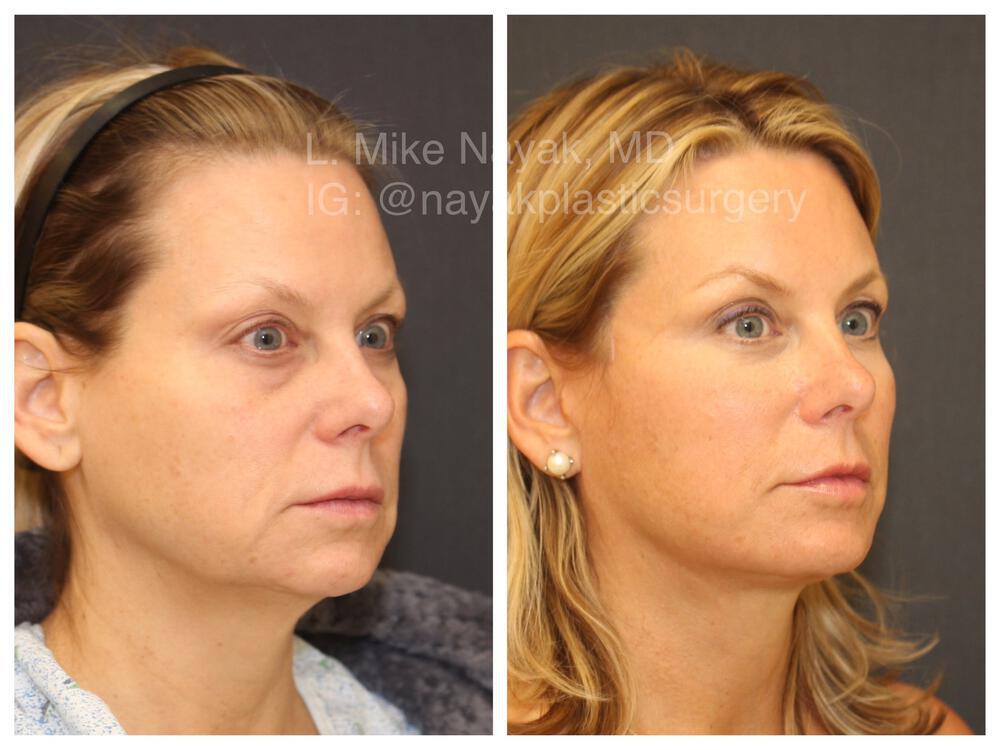 Blepharoplasty Before & After Image