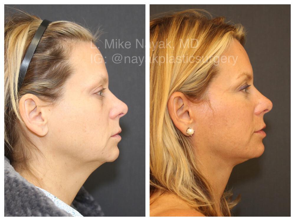 Blepharoplasty Before & After Image