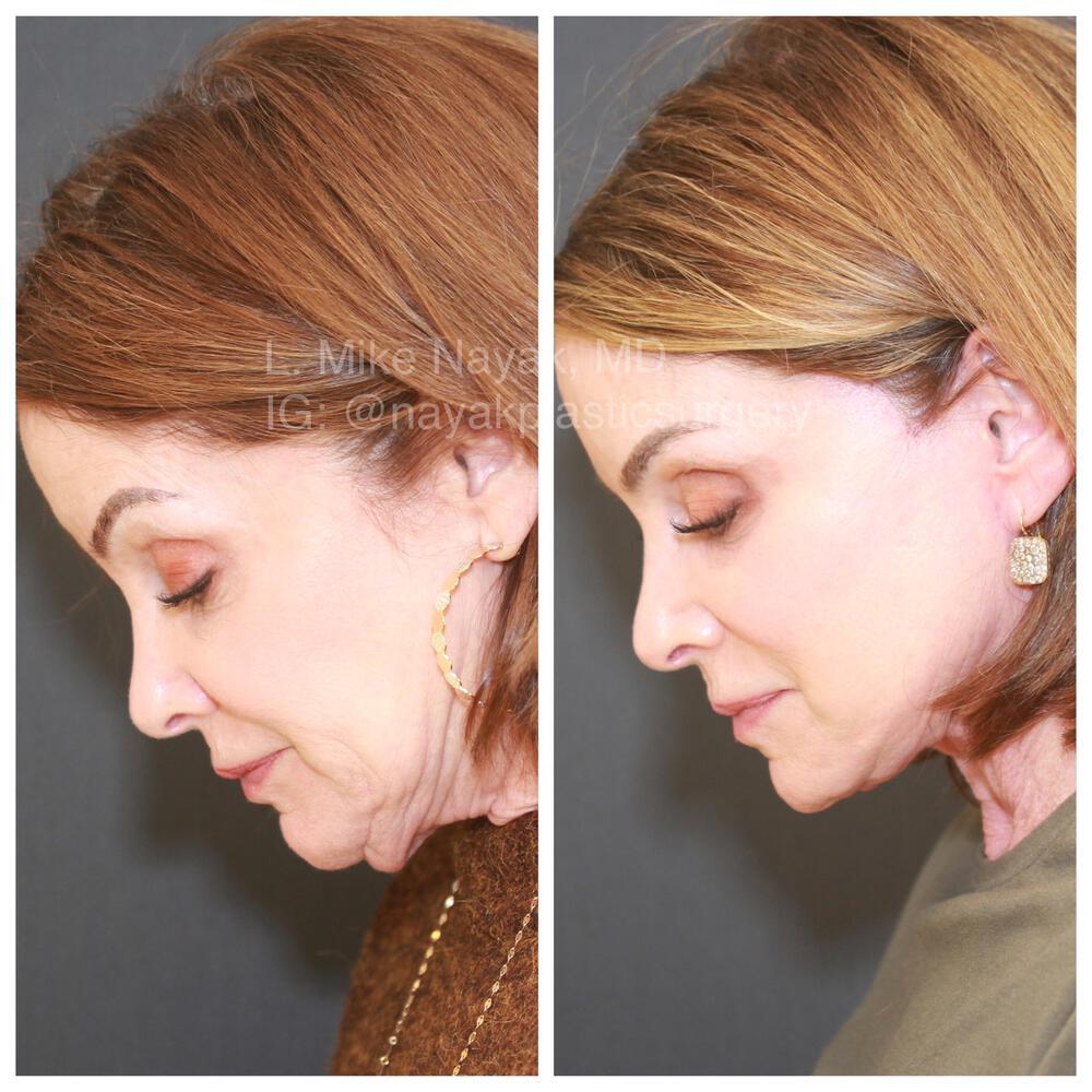 Blepharoplasty Before & After Image