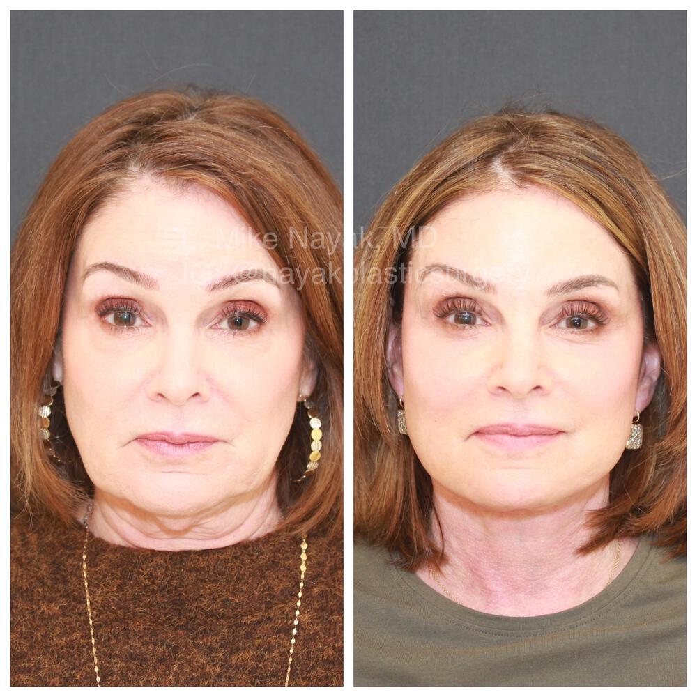 Blepharoplasty Before & After Image