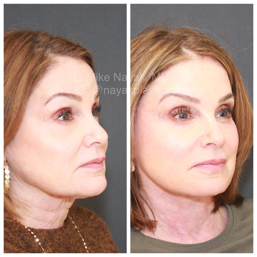 Blepharoplasty Before & After Image