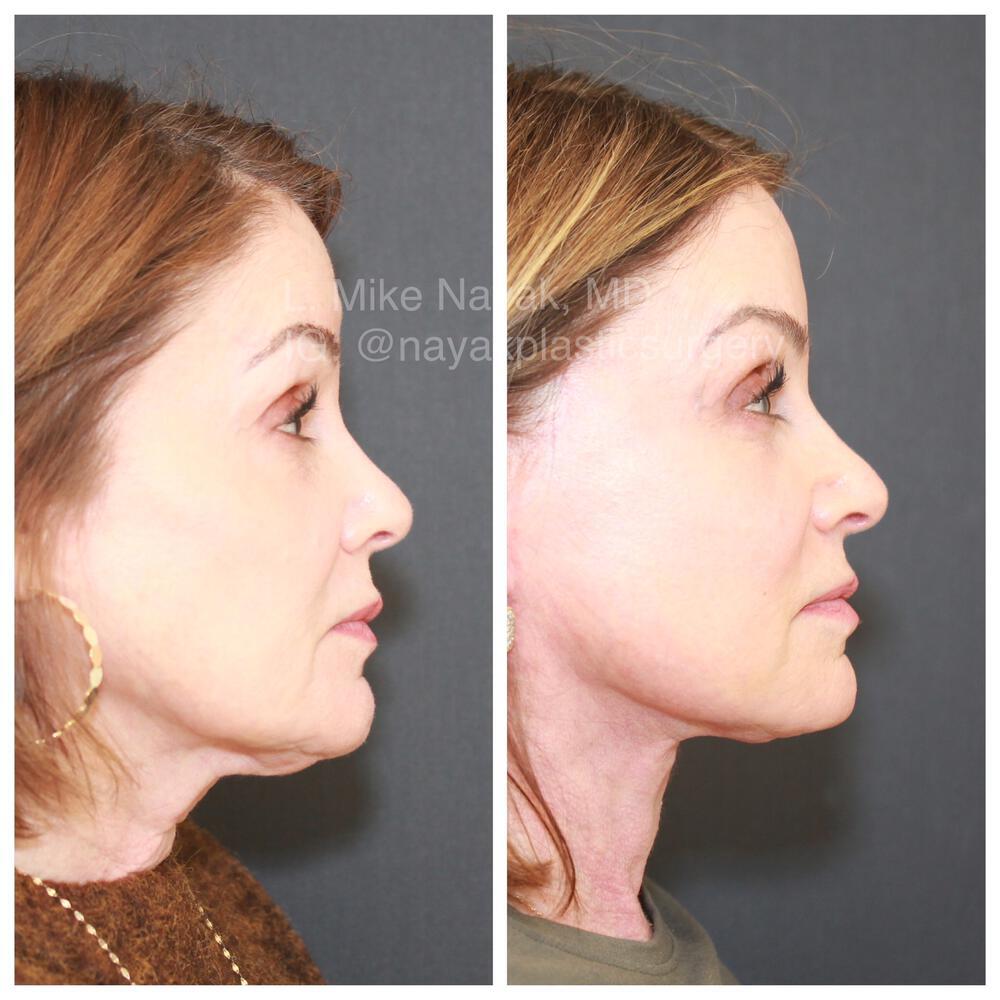 Blepharoplasty Before & After Image