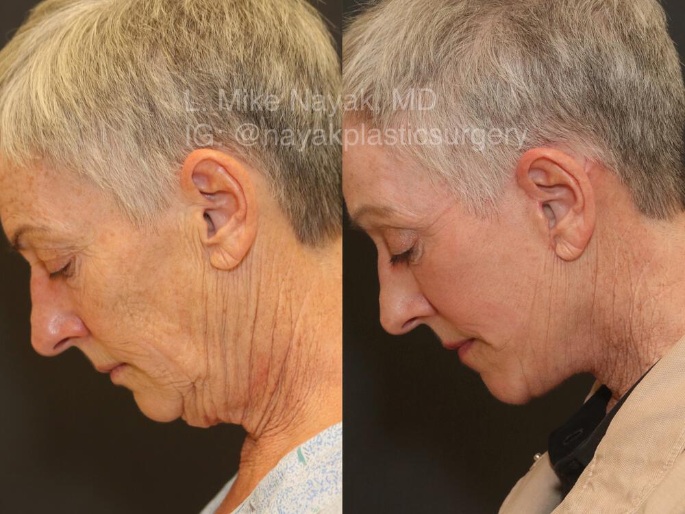 Blepharoplasty Before & After Image