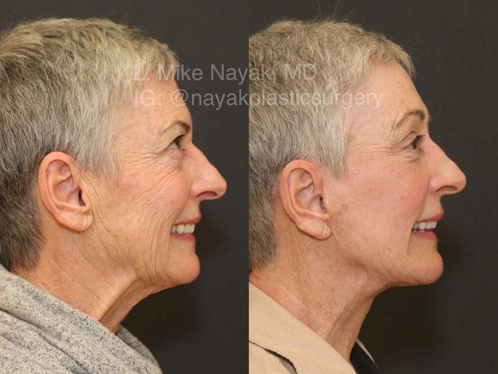 Blepharoplasty Before & After Image