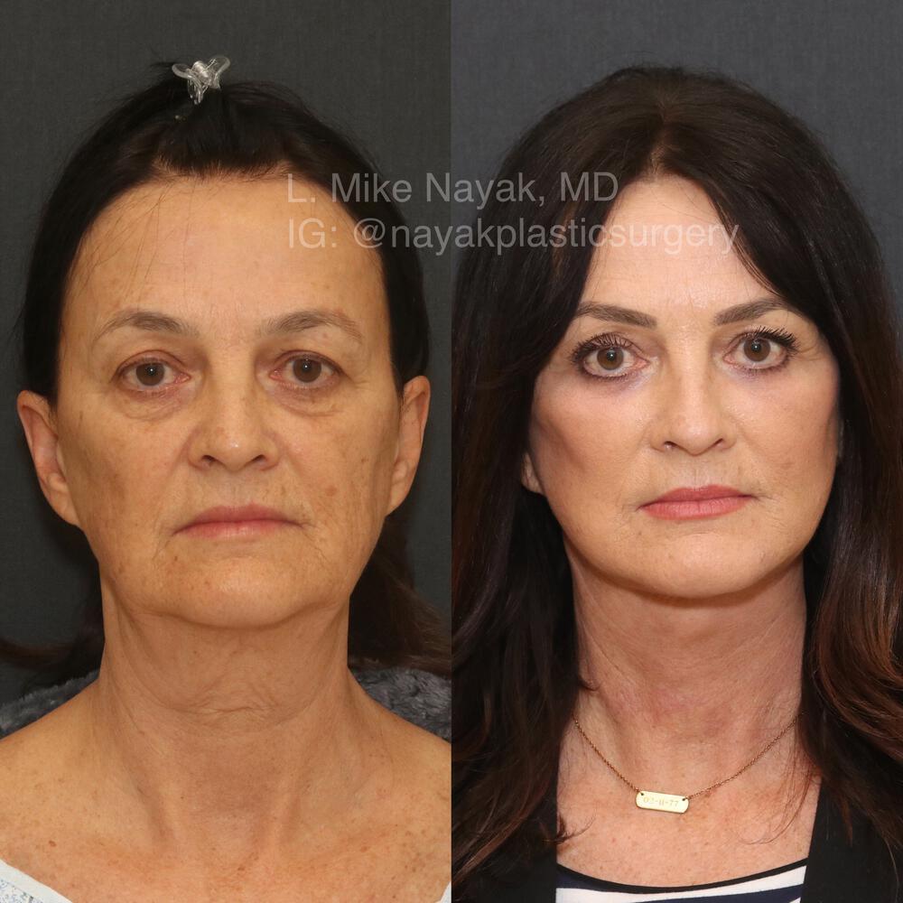 Blepharoplasty Before & After Image