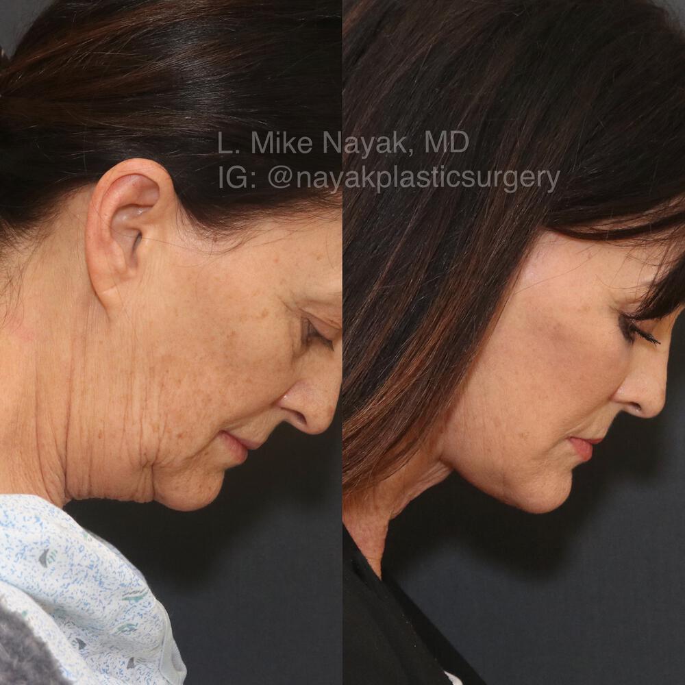 Blepharoplasty Before & After Image