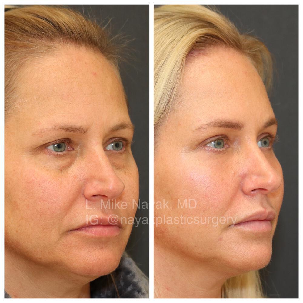 Blepharoplasty Before & After Image