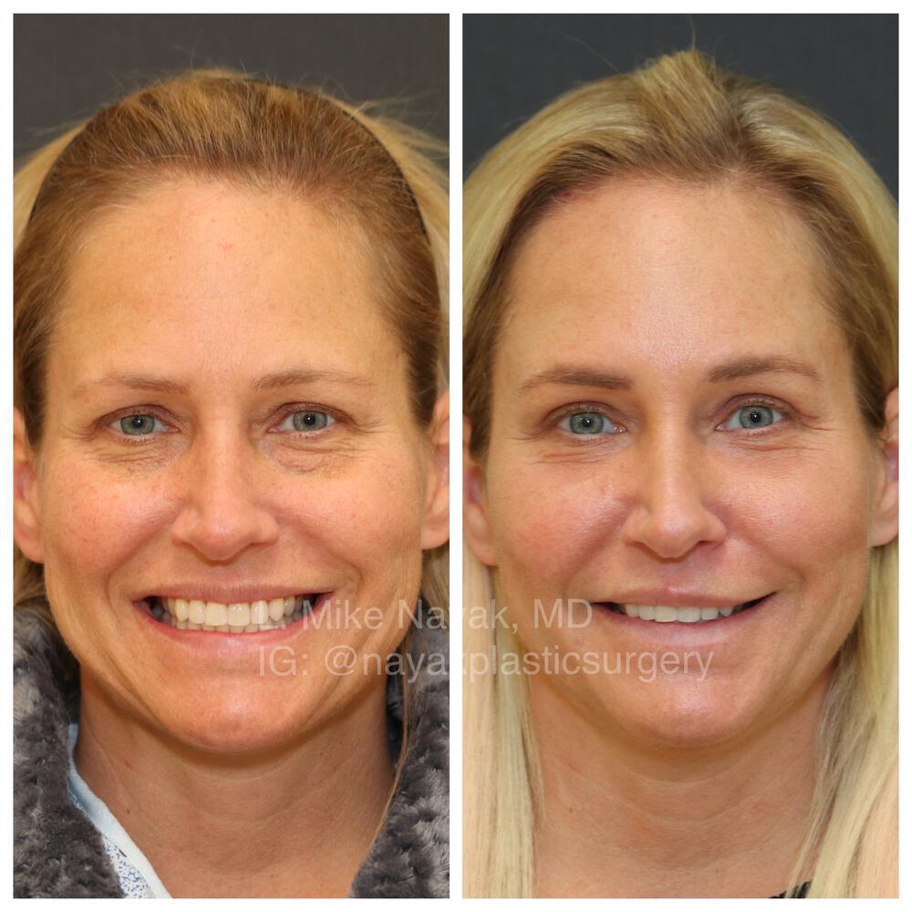 Blepharoplasty Before & After Image