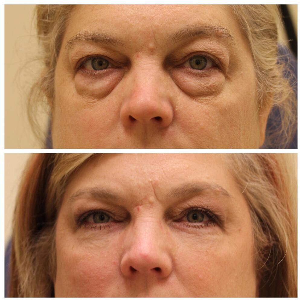 Blepharoplasty Before & After Image