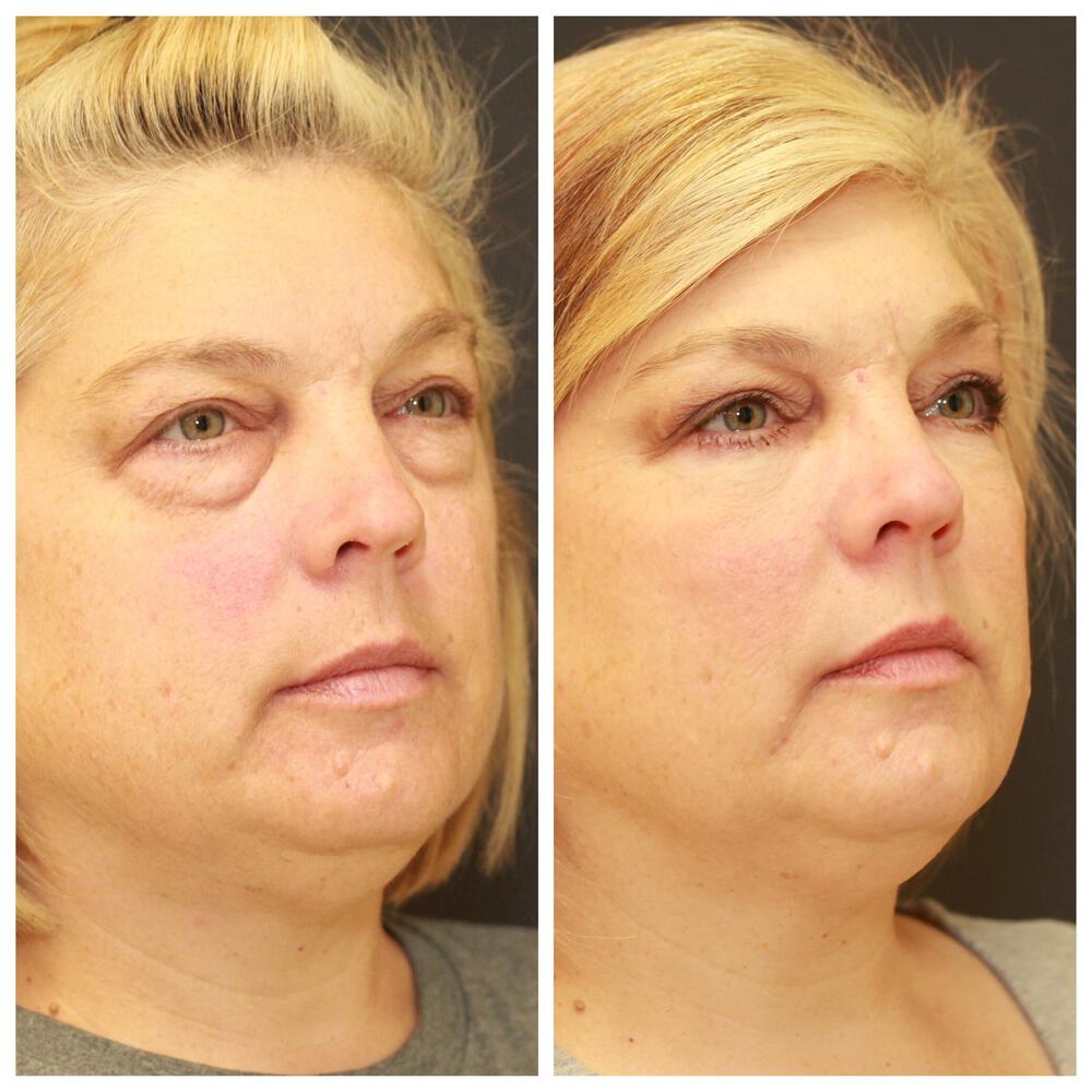 Blepharoplasty Before & After Image