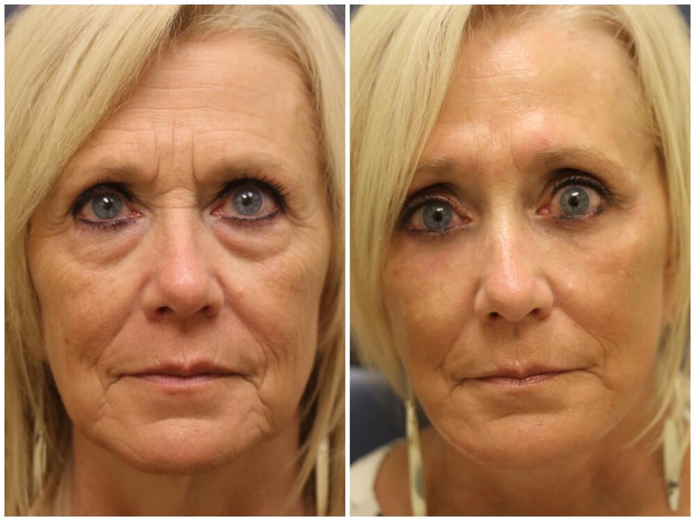 Blepharoplasty Before & After Image