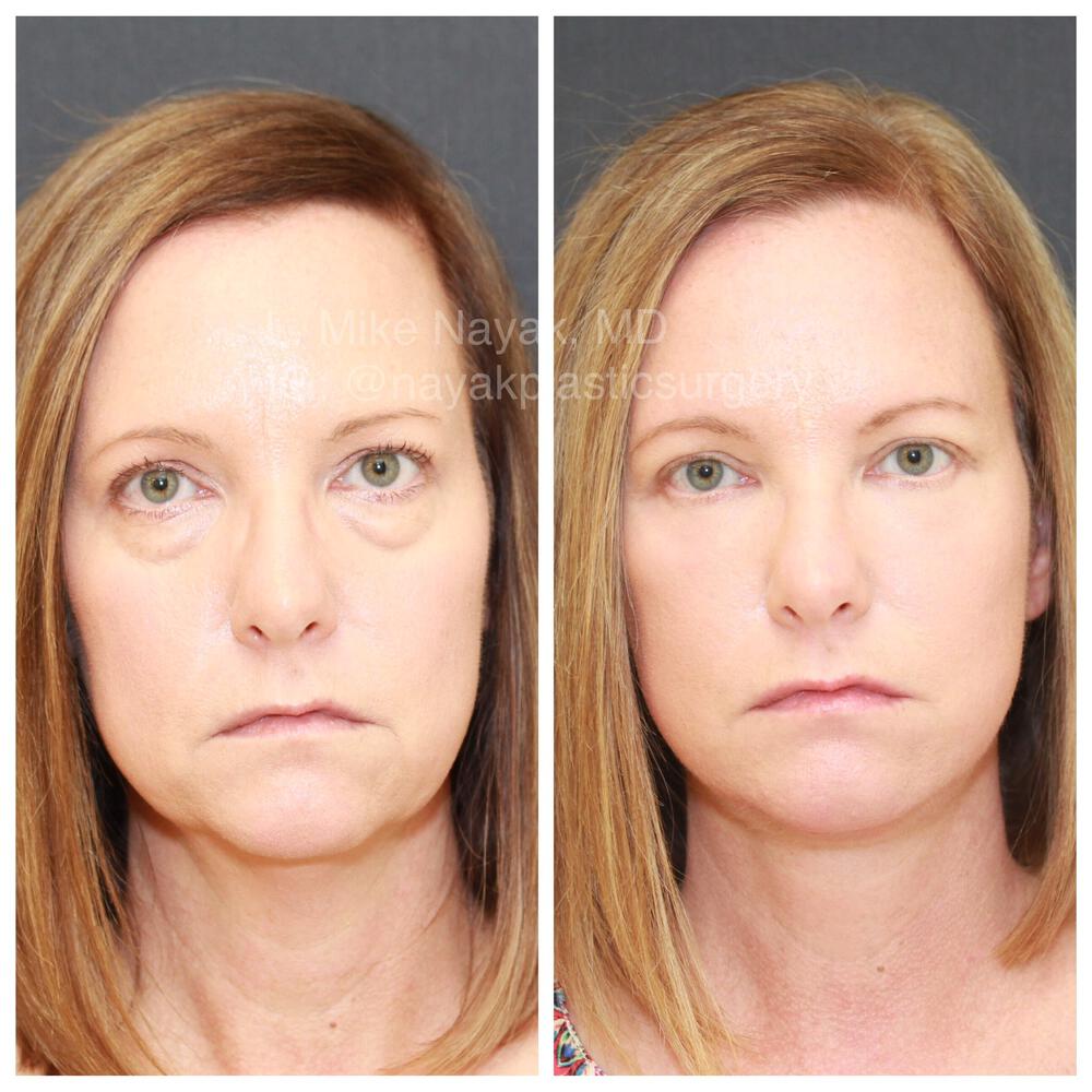 Blepharoplasty Before & After Image