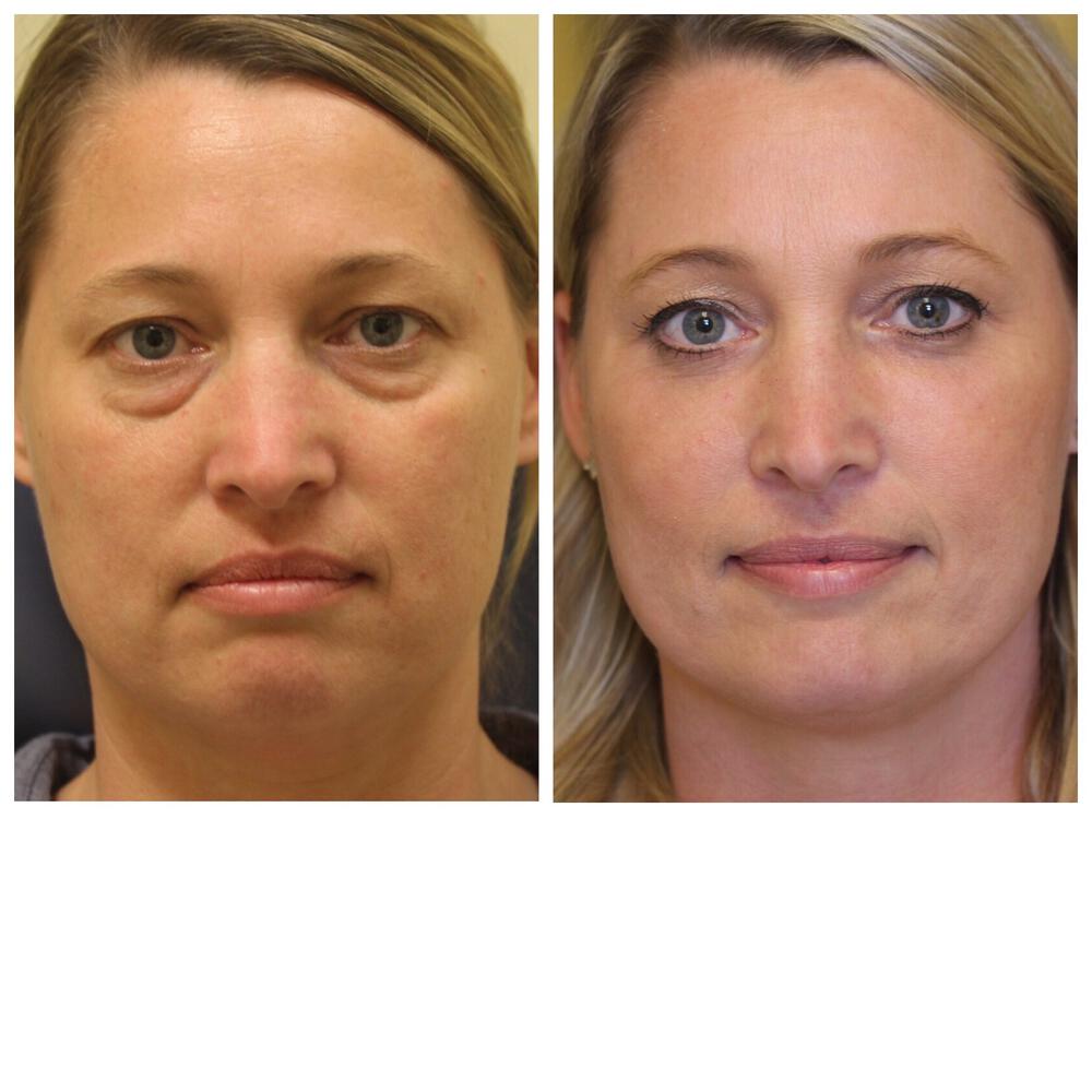 Blepharoplasty Before & After Image