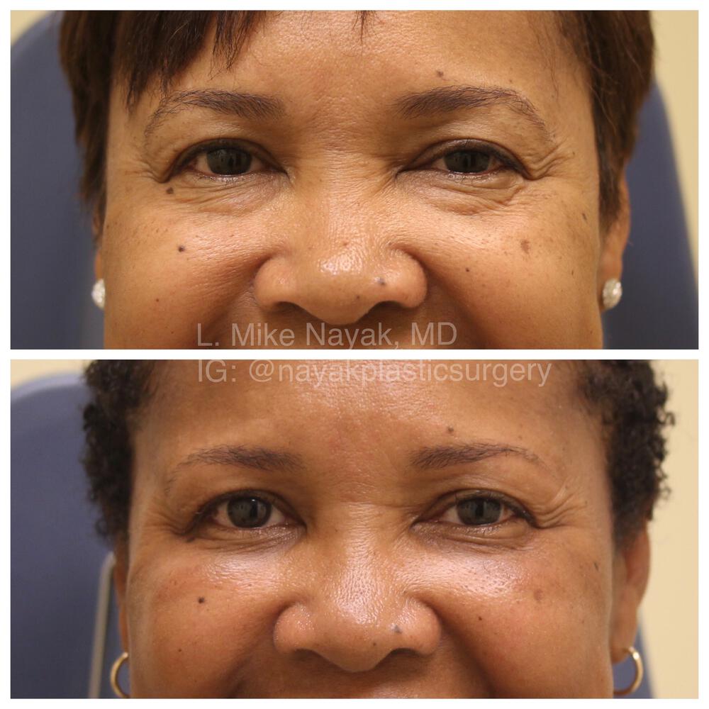 Blepharoplasty Before & After Image