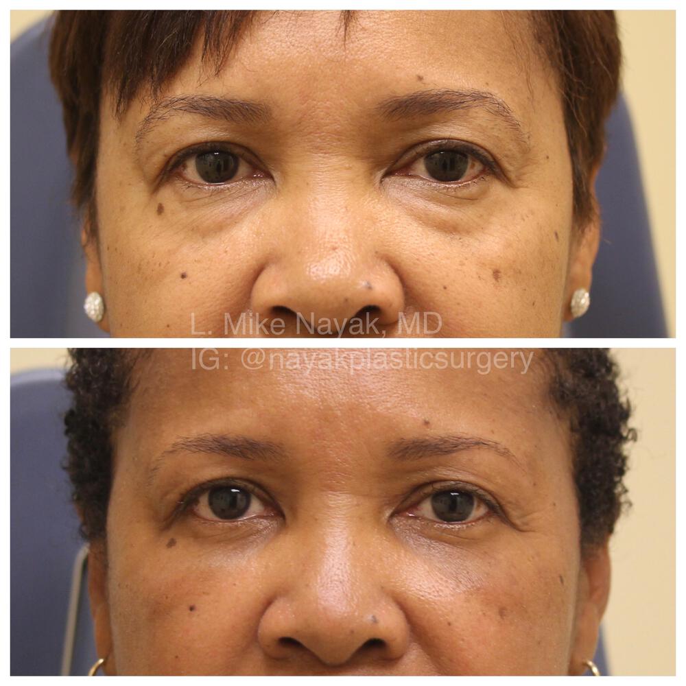 Blepharoplasty Before & After Image