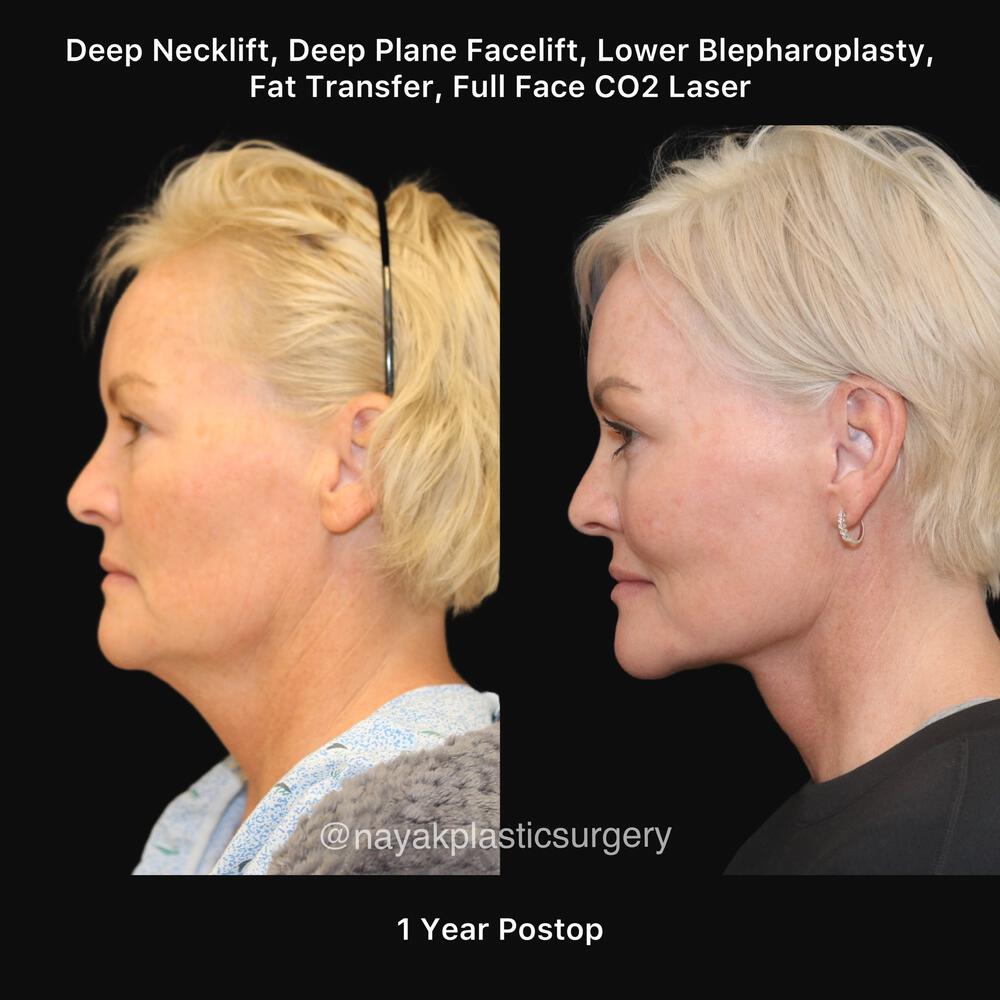 Blepharoplasty Before & After Image