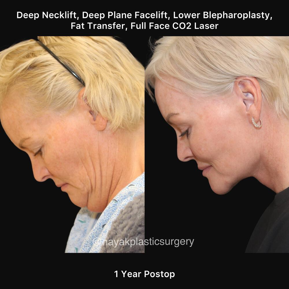 Blepharoplasty Before & After Image