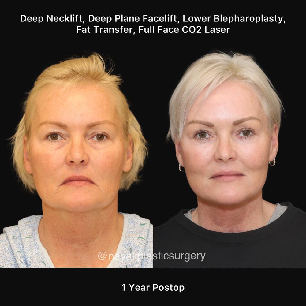 Blepharoplasty Before & After Image