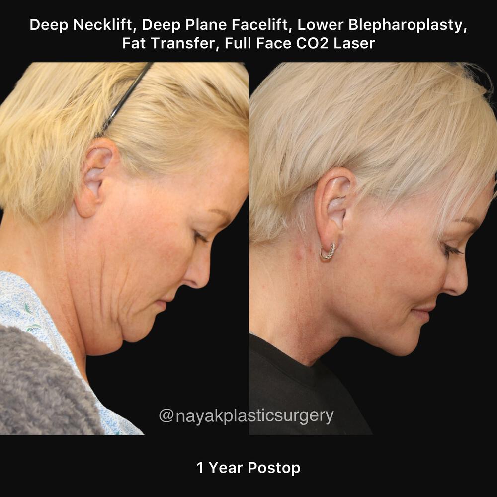 Blepharoplasty Before & After Image