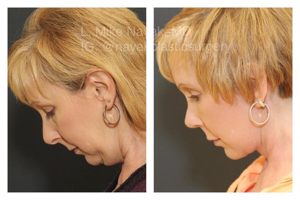 Blepharoplasty Before & After Image