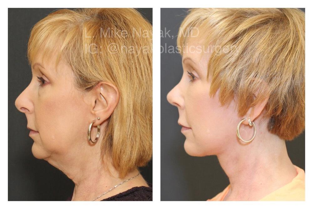 Blepharoplasty Before & After Image