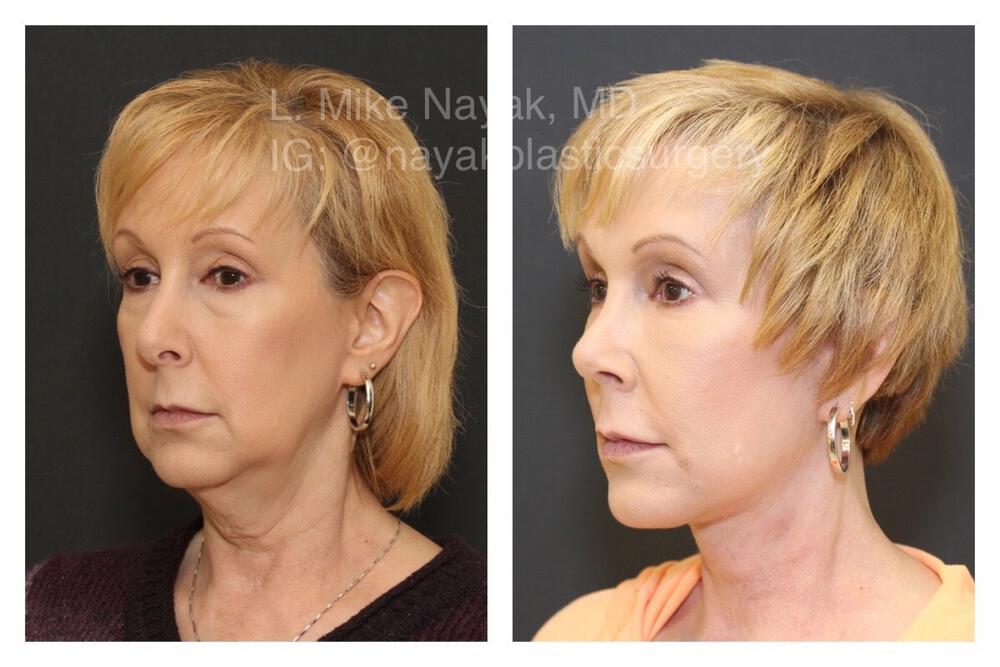 Blepharoplasty Before & After Image