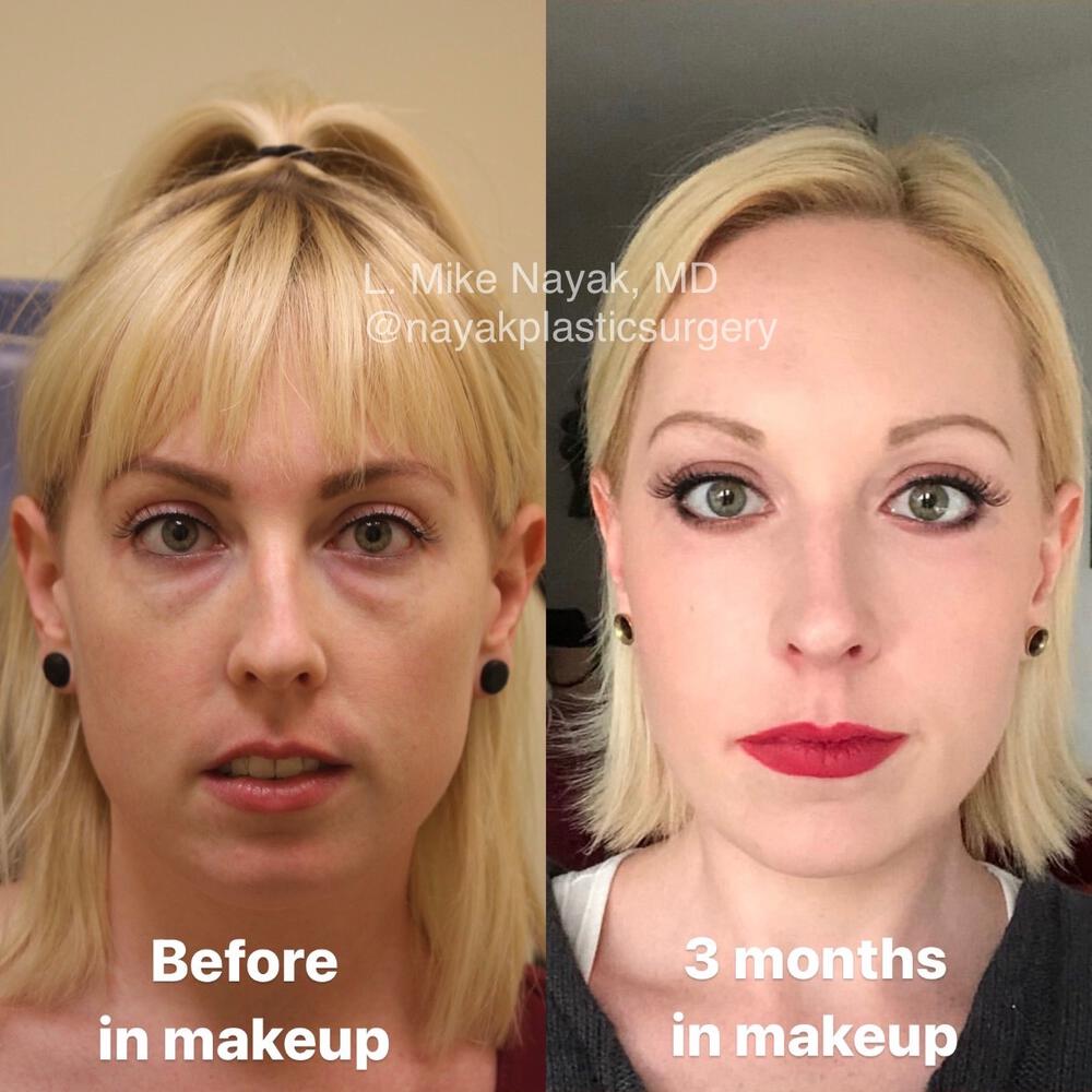 Blepharoplasty Before & After Image